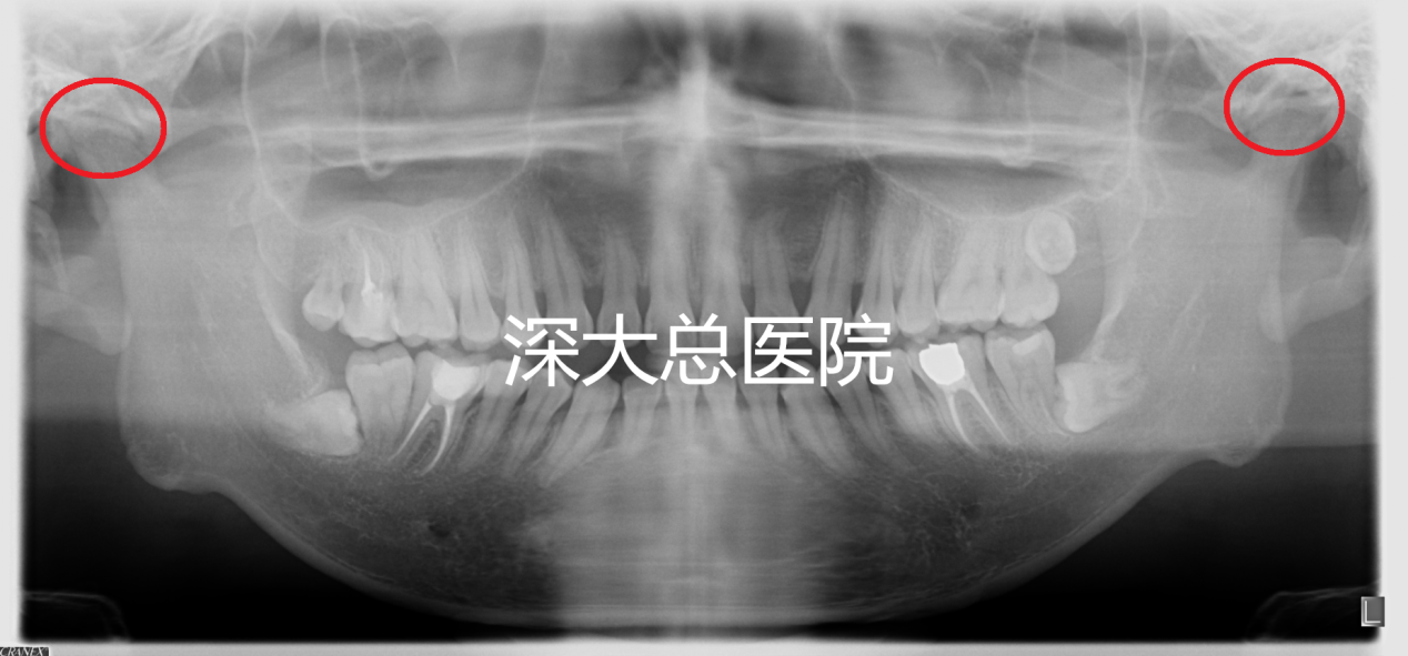 (患者术前全景示双侧髁突吸收)