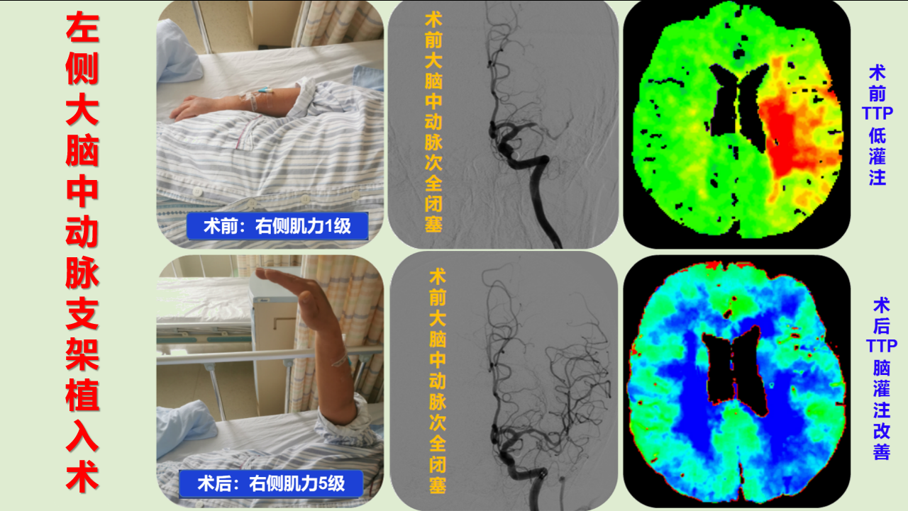 3左侧大脑中动脉支架植入术.png