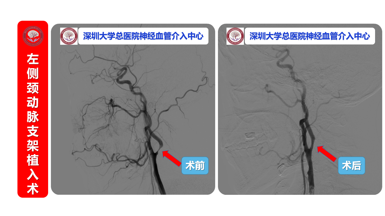 4左侧劲动脉支架植入术.png