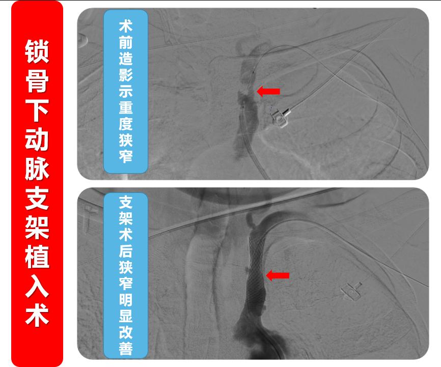 6锁骨下动脉支架植入术.png