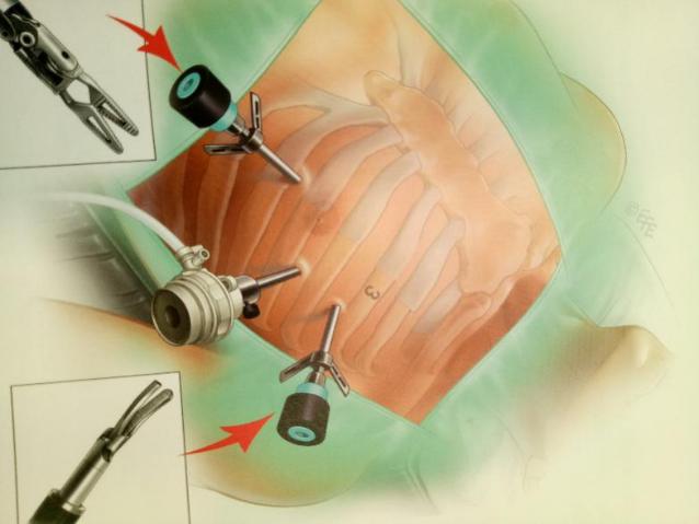劈开直视手术如果按照传统的胸骨正中劈开入路施行手术(图2),切口长